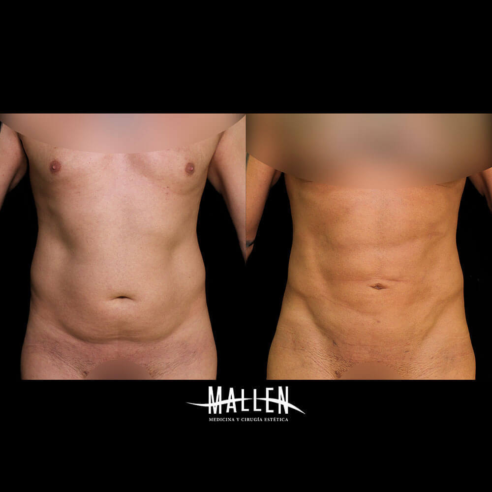 A_D-6786-Lipotransformacion-recortada