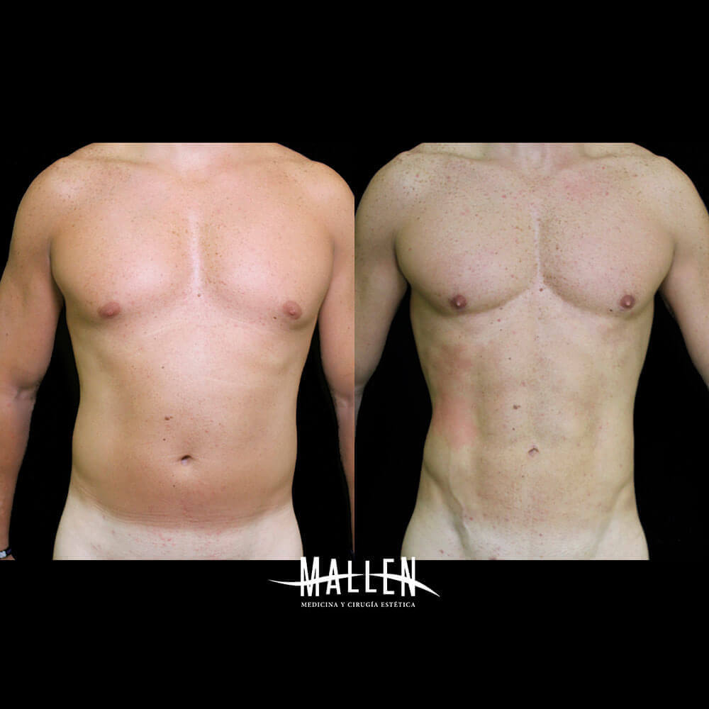 A_D-Lipotransformacion-man1-recortada