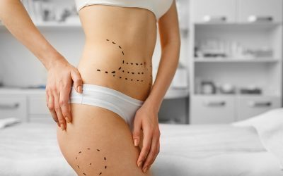 Abdominoplastia o liposucción: ¿cuál es mejor?