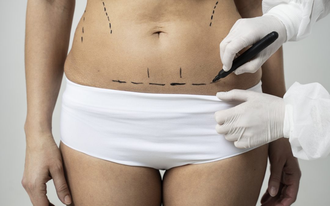 Lipoescultura abdominal, todo lo que debes saber