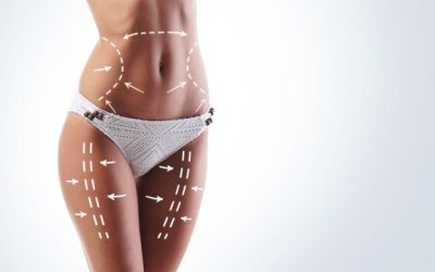 6 ventajas de la liposucción con tecnología BodyTite